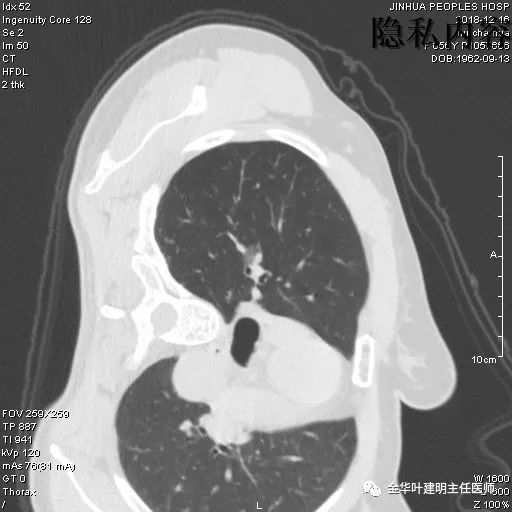 經驗積累讓子彈再飛一會兒混合磨玻璃結節並不都是癌