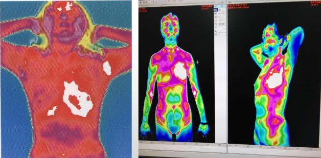 医用红外热像仪可以看出哪些病灶?tmt生命热图病例分析