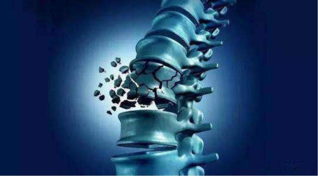 刷个牙结果腰断了打个喷嚏竟然骨折了罪魁祸首就是它