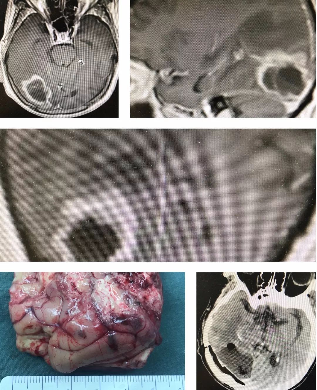 小結:腦轉移瘤切除的理想手術方式是完整切除,術中不接觸腫瘤,避免