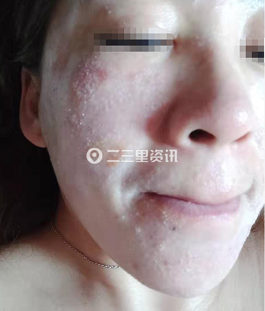 差点被毁容?辽源女子投诉:使用理肤泉护肤品后脸部流脓 眼睛封喉