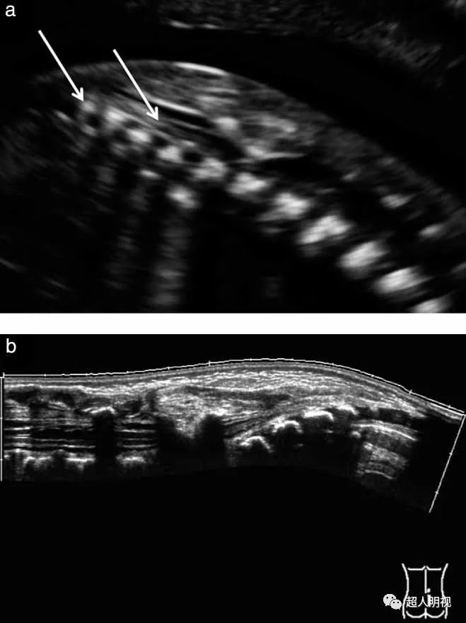 b)产后超声图像显示脊髓纵裂,脊髓拴系和皮下脂肪瘤
