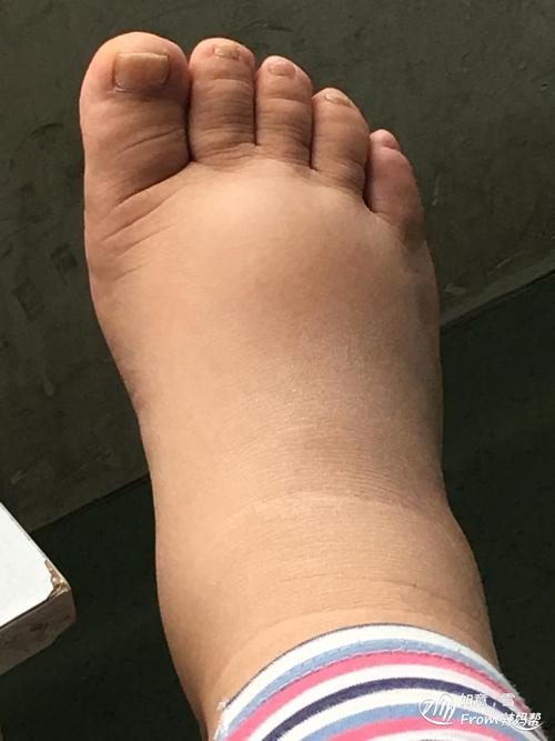 我们都知道很多小伙伴并不是胖而是水肿,而缺乏蛋白质很可能就会造成