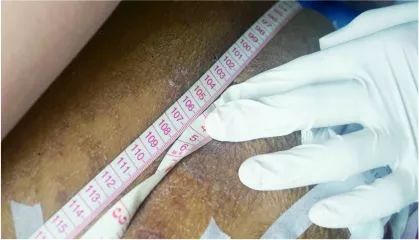 小心肚子大可能不是肥胖是肝腹水惹的祸