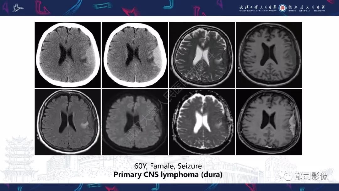 肥厚性硬脑膜炎影像诊断