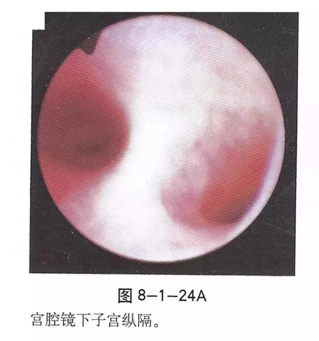 宫腔镜人流 来自搜狐网