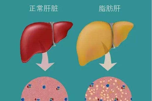 根据《中国脂肪肝治疗指南)》显示,我国成人脂肪肝患病率已经达到12