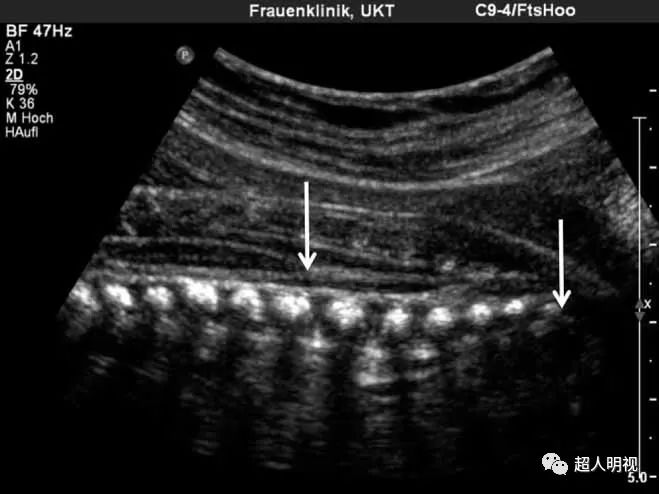胎儿脊髓圆锥位置图片