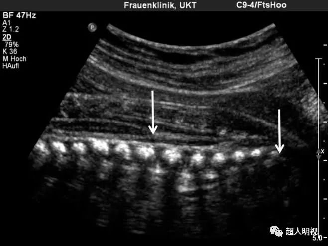 胎儿脊髓圆锥超声图片图片