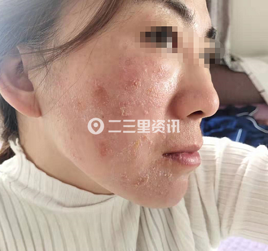 差点被毁容?辽源女子投诉:使用理肤泉护肤品后脸部流脓 眼睛封喉