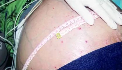 腹水消除前患者腹围腹水消除后患者腹围