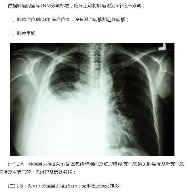 家属问 早期癌症还是中晚期怎么确定癌症分期 搜狐大视野 搜狐新闻 家属问 早期癌症还是中晚期怎么确定癌症分期 搜狐大视野 搜狐新闻