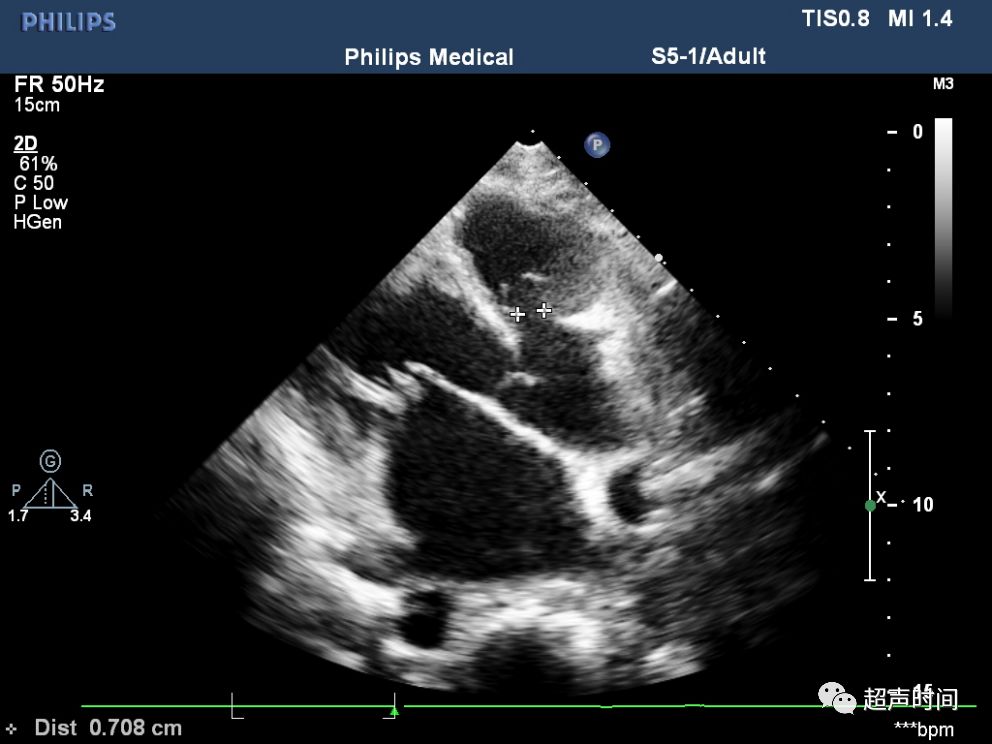 超声典型病例:主动脉右冠窦瘤破入右室