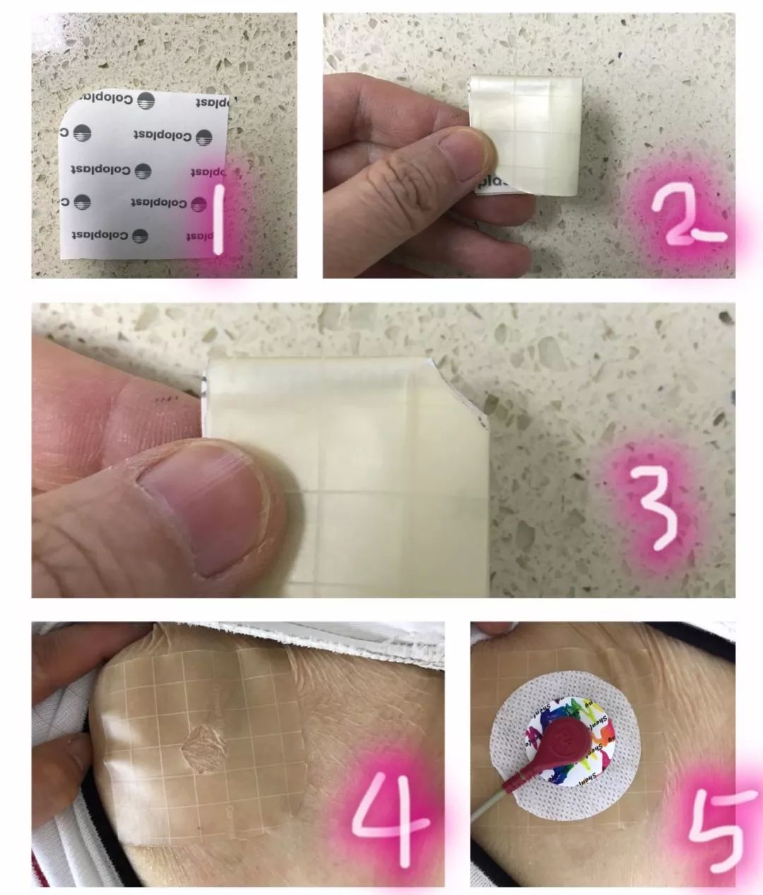 心电监护时,病人电极片过敏怎么破?