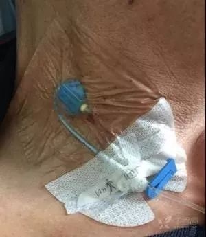 如果用纱布衬垫植入式输液港中无损伤针的翼柄,但未遮住穿刺部位,不