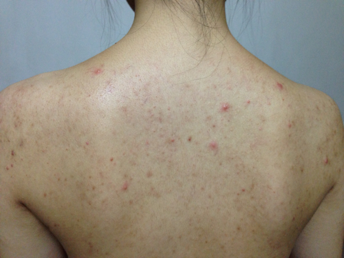 背部长痘搓澡搓出大量泥垢原来是螨虫排泄物排螨3方法搞定