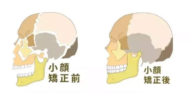 seas小颜是徒手矫正面部骨骼,但不是整容,只是会把移位骨骼矫正回相对