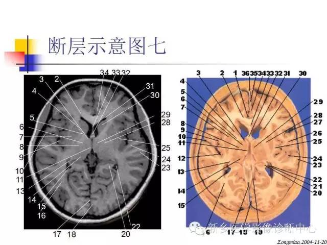 腦磁共振局部解剖功能圖解