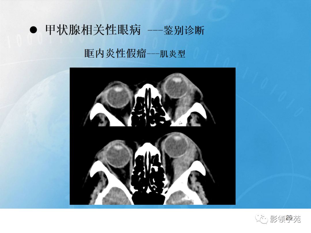 甲状腺相关性眼病影像学表现有哪些?_graves