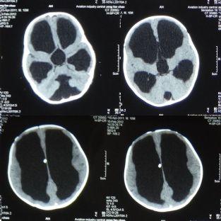 11个月婴儿感冒后发现竟有脑积水,治疗婴儿脑积水的好方法_头颅