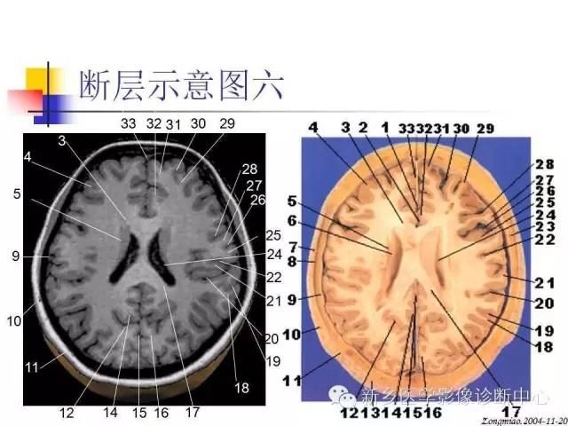 腦磁共振局部解剖功能圖解