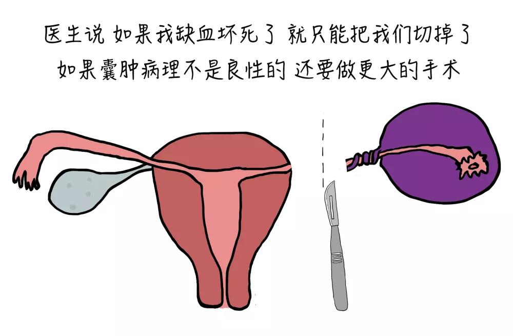 敲黑板1,卵巢肿瘤蒂扭转是卵巢肿瘤最常见并发症.