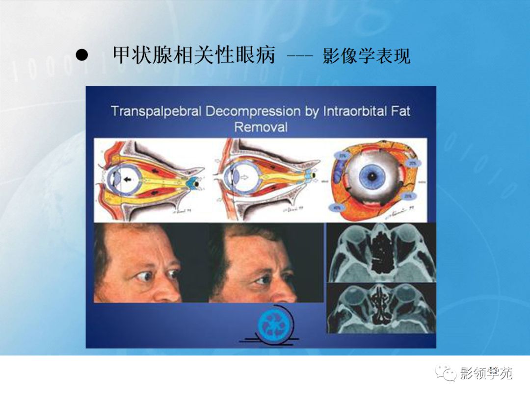 甲狀腺相關性眼病影像學表現有哪些