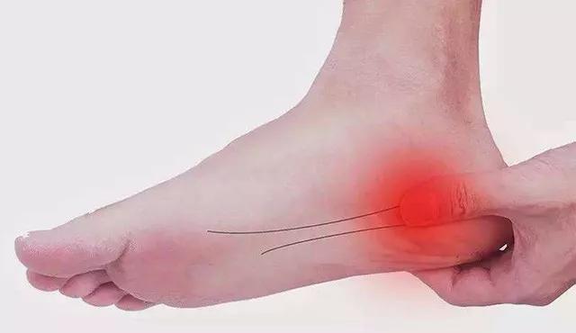 足跟痛学会这几招自己在家就能治深圳医家人运动康复