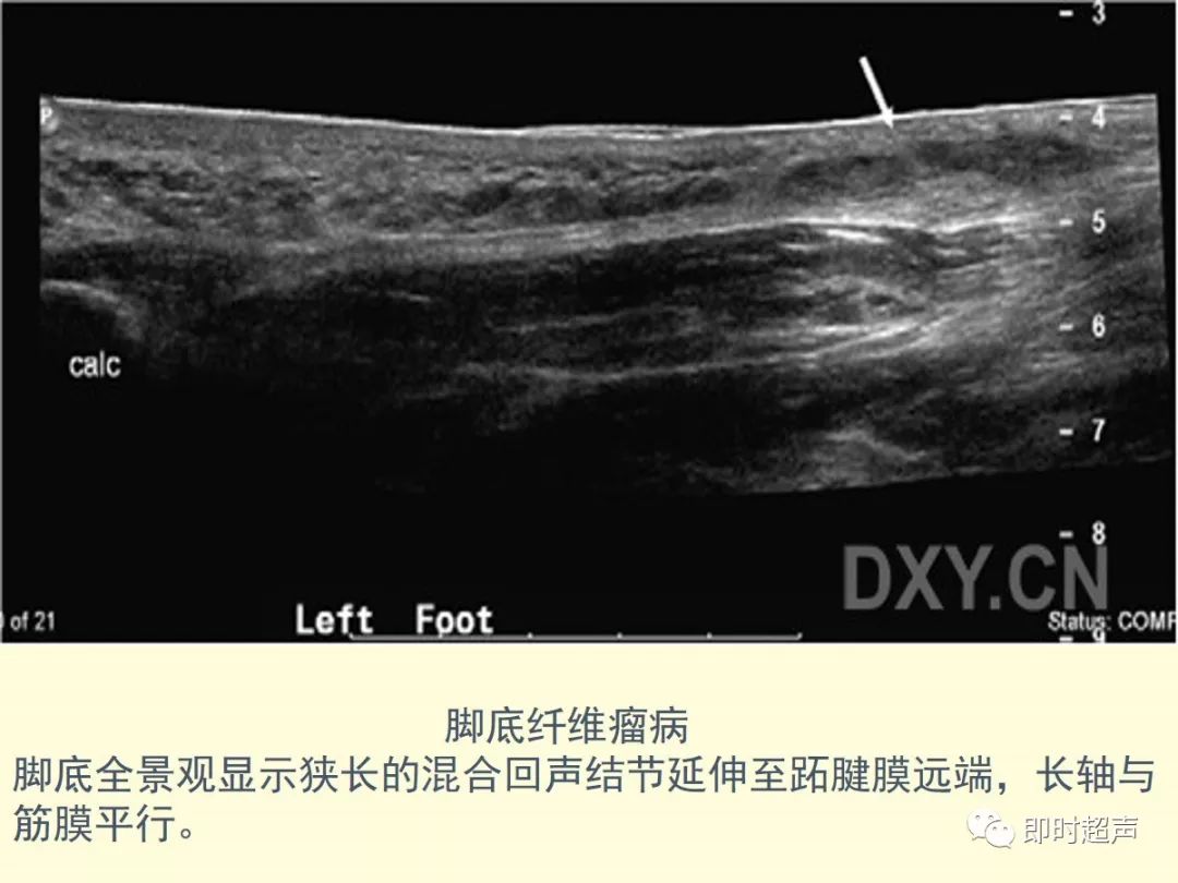 肌肉软组织肿物的超声诊断