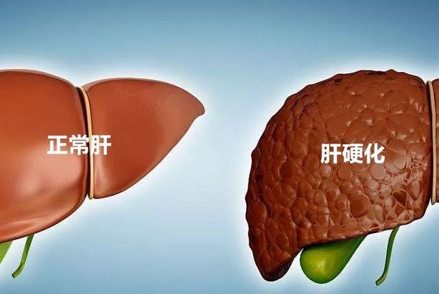 容易因为大量饮酒和食用油腻食物,大量米饭等碳水化合物而导致脂肪肝