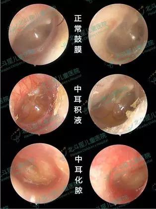 北斗星唇腭裂康复中心丨腭裂需要做的听力相关检查家长一定不能忽视