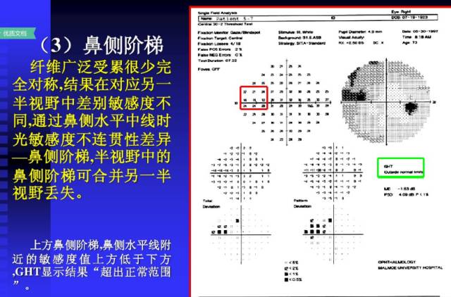 视野检查结果分析基础知识