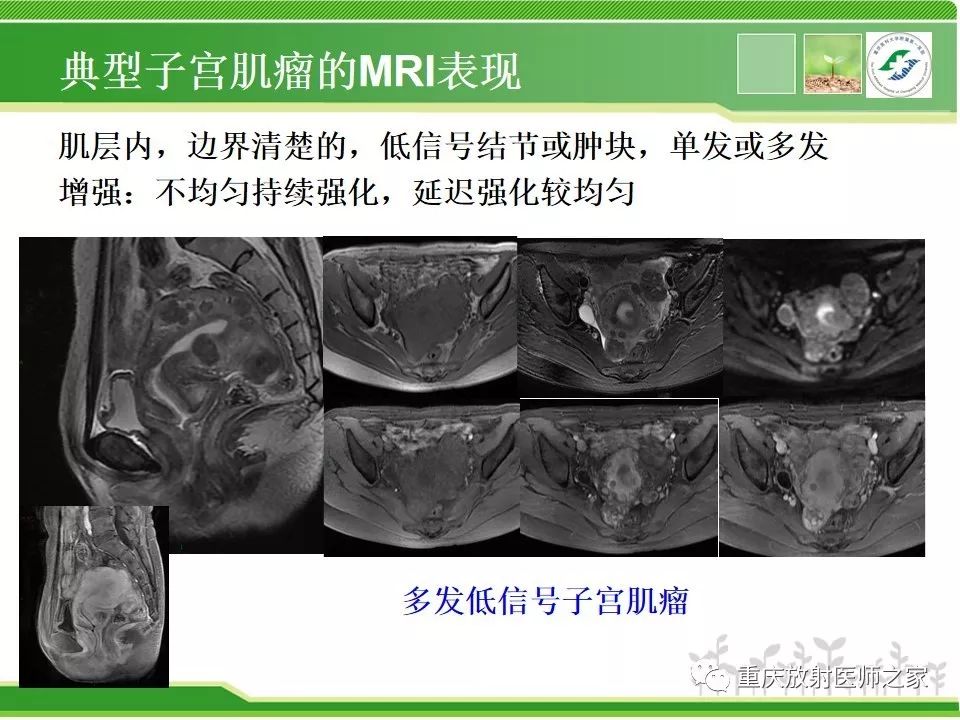 周末学习子宫肌瘤实用影像学诊断