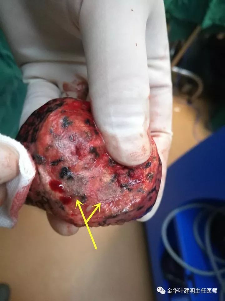 如此早期的肺结节你能发现吗