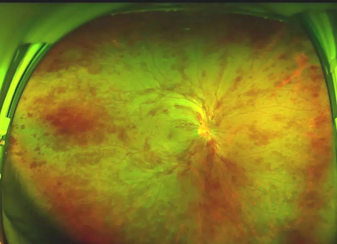 眼底检查神器欧堡超广角眼底相机入驻市一院