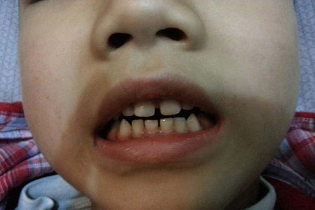 宝宝牙齿畸形影响整体颜值怎么办儿童牙齿畸形到底应该怎么做