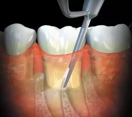 ①牙周袋到底长什么样?