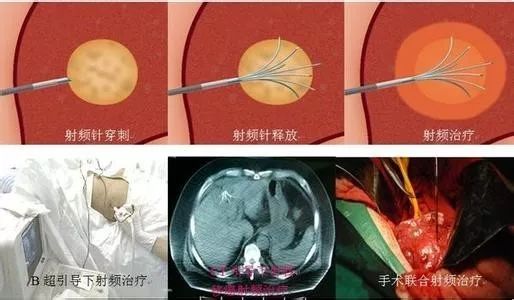 腹腔镜下肝癌射频消融术您了解多少
