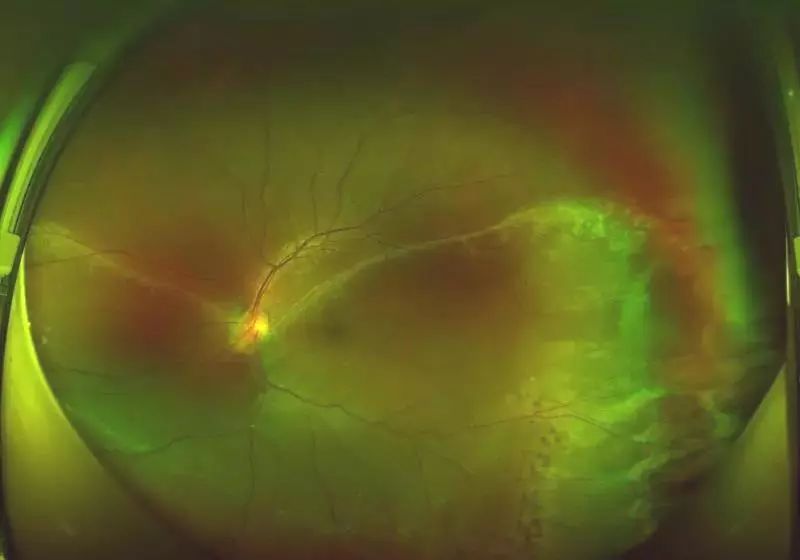 眼底检查神器欧堡超广角眼底相机入驻市一院