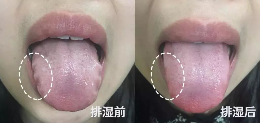 小萌:典型湿气重,平时老觉得睡不够,没精神,舌苔边缘呈锯齿状,这款