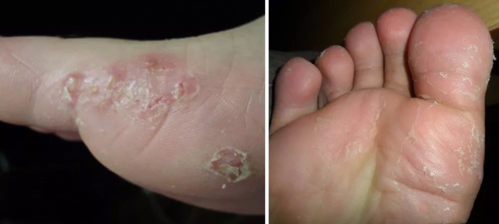 洗脚加一物杀菌除臭去死皮秒变白白嫩嫩