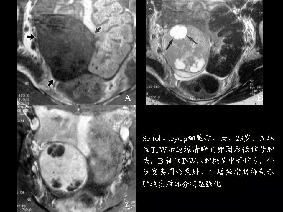 卵巢囊腺瘤ct表现图片图片