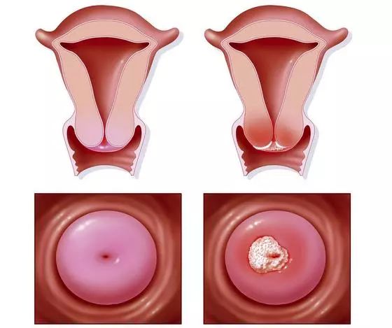 同房后阴道出血了,患上宫颈癌了?不一定