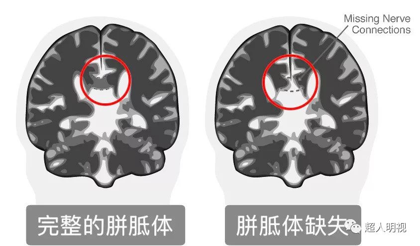 胎儿胼胝体缺失