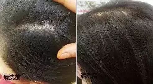 头螨喜欢吃头皮油脂,啃食发根为生,并且分泌解脂酵素,侵蚀皮脂腺,阻塞