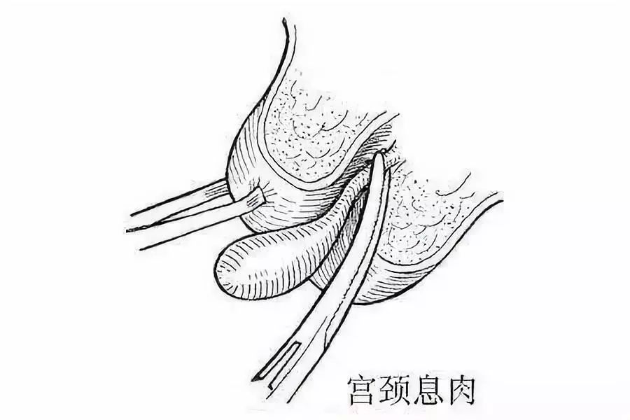 同房后阴道出血了,患上宫颈癌了?不一定