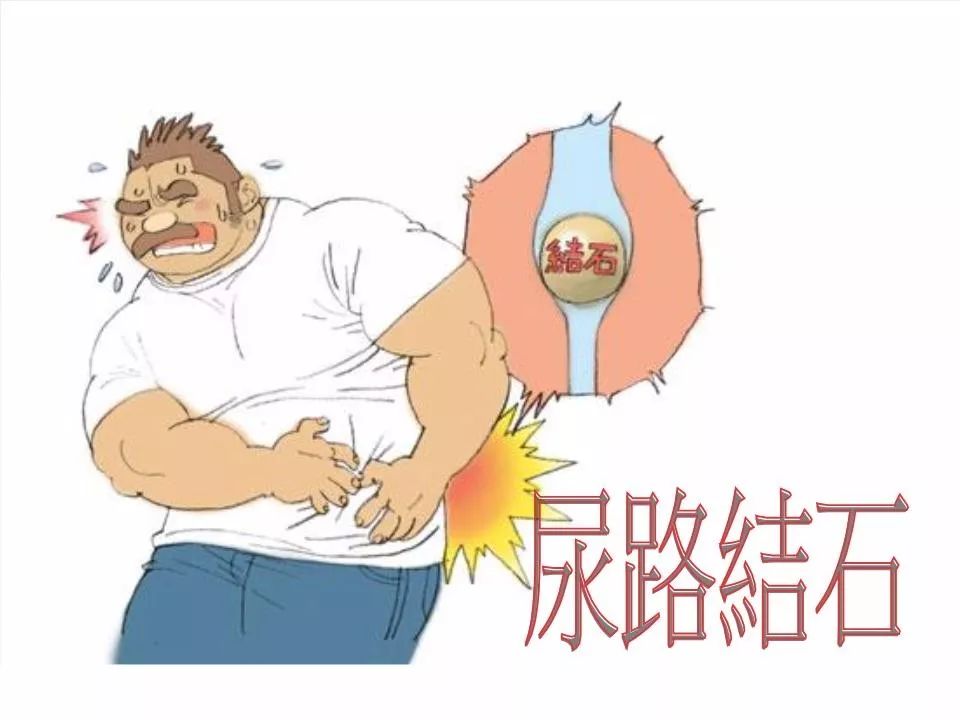 警惕尿路结石并发重症感染严重时会危及生命