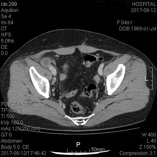 急性阑尾炎ct片 图片图片