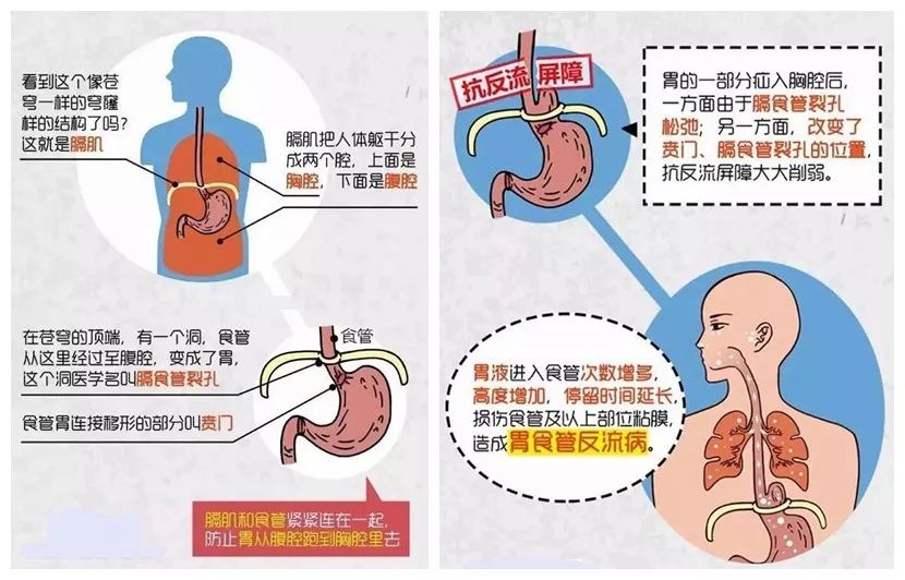 原來分隔人體胸腔和腹腔的膈肌上有個孔洞,叫食管裂孔.