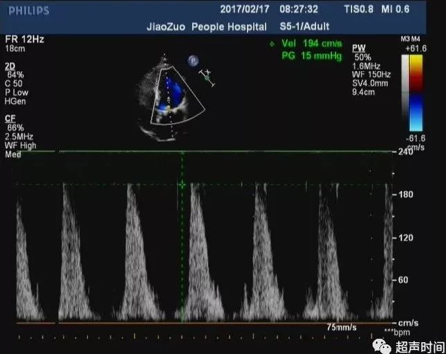 心臟人工瓣膜:有些超聲知識點和你想象的不一樣_二尖瓣